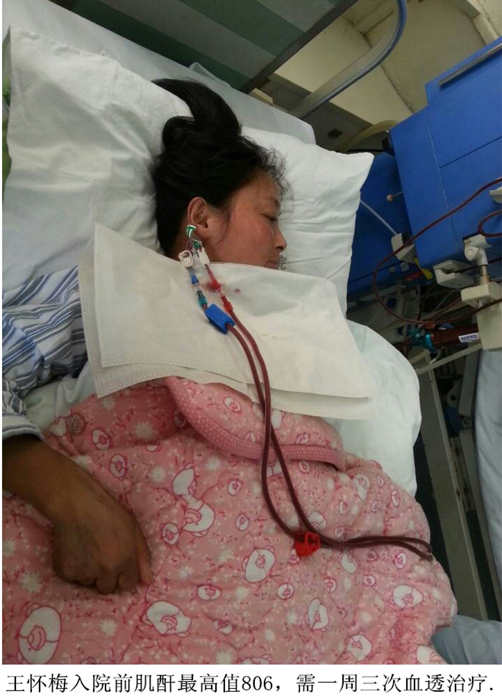 尿毒症血透女患者入院70天,肌酐624降至341摆脱血